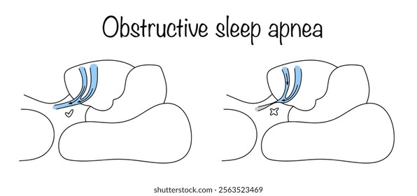 A dangerous disease in which a person’s upper respiratory tract collapses repeatedly during sleep, as a result of which air cannot enter the lungs and saturate the blood with oxygen.