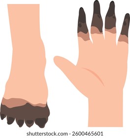 Dangrene. Foot And Hand Vector Illustration