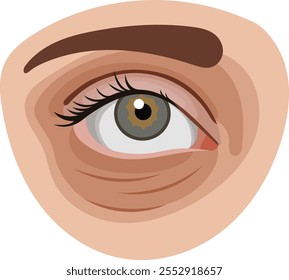 Dark Circle Under Female Eye Illustration Isolated on White Background
