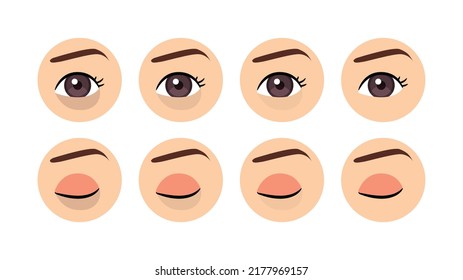 Dark Circles Under the Eye. Female Open and Closed Eye. Treatment of Periorbital Circles. Before After. Healthy Skin. Color Cartoon style. White background. Vector image for Medical and Beauty design