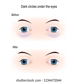 Dark circles under the eyes. Before and After Filler injection under the eyes. Removal of dark circles around the eyes. care for eye skin. Vector diagram for skin care, and medical use