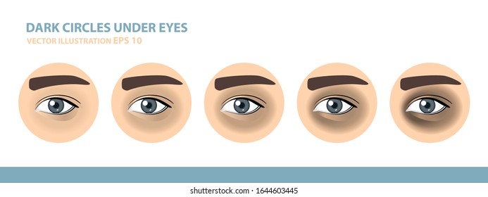 Dark Circles Under Eyes. Male Eye. Vector Illustration