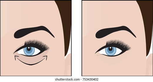 Dark circles under eyes to remove. Vector illustration