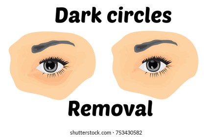 Dark circles under eyes to remove. Vector illustration