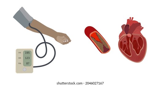 Una mano de piel oscura y un autónomo con hipertensión, presión arterial alta. La aterosclerosis causa un aumento del corazón. Ilustración médica de vector plano.