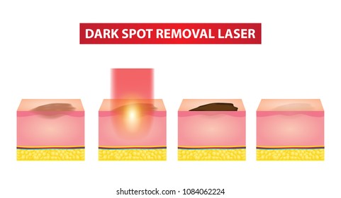 Dark spot laser steps vector illustration