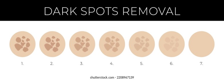 Ilustración de eliminación de puntos oscuros con pasos de desvanecimiento de melasma