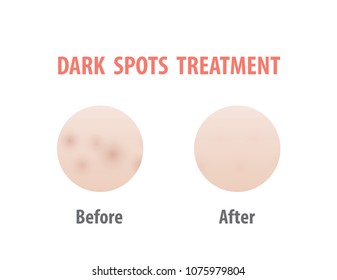 Dark Spots Treatment Comparison Illustration Vector On White Background. Skin Concept.