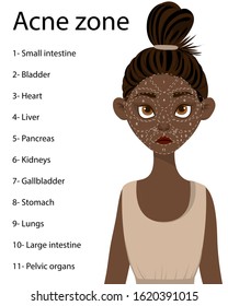 Dark-skinned girl with a scheme of problem areas on her face with a predisposition to acne. Cartoon style. Vector illustration