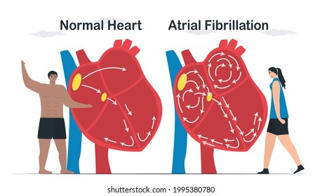 Data comparison of Normal heart and Atrial fibrillation. AF is common type of irregular heartbeat. Electrical signals in atrium cause atrium to beat quickly and erratically. cardiology vector.