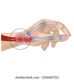 De Quervain disease. Occupational disease of the hand. Inflammation of the tendon sheath.