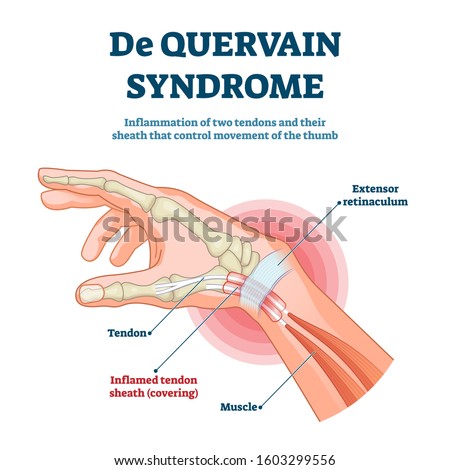 De Quervain syndrome vector illustration. Labeled thumb inflammation scheme. Painful disease diagnosis anatomical explanation. Hand tendon sheath covering pathology diagram. Chronic health problem.