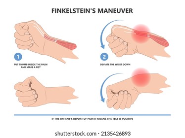 Finkelstein manipula el diagnóstico de inflamación de los tendones de la muñeca