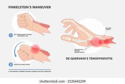 De quervain's pain tendon thumb wrist hurt grasp make a fist sport muscle hand Finkelstein's test bend brace finger strain trigger carpal tunnel brevis Eichhoff's stretch radial Grip spring relief