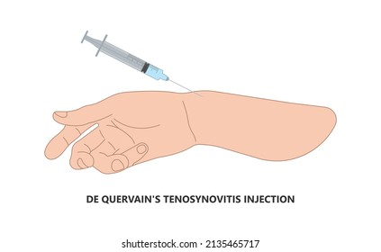 Disparo el tratamiento quirúrgico del pulgar para aliviar el dolor