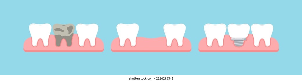 Dead tooth, lost stage and dental implant in gum isolated on blue background. Healthy human teeth and implant prosthesis concept. Flat design cartoon style vector orthodontist dentistry illustration.