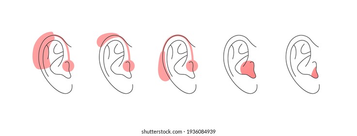 Deaf and hear aid concept. Vector flat illustration set. Collection of hearing aid device in outline human ear silhouette isolated on white. Design element for medicine, health care.