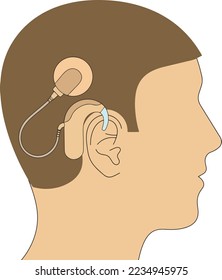 deaf person with a cochlear implant