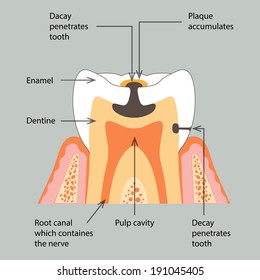 Decay tooth.