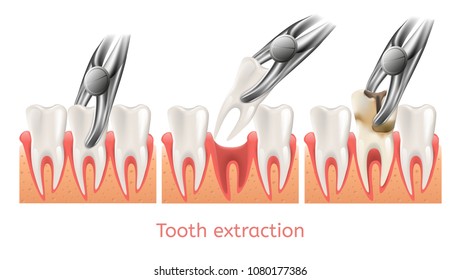 Tooth Anatomy Stock Vectors, Images & Vector Art | Shutterstock