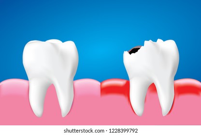 Decay tooth with inflammation and healthy tooth, Dental care concept, Realistic illustration Vector.