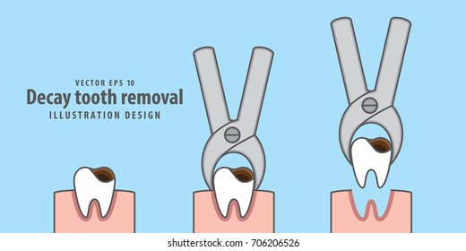 Descomponer el vector de ilustración de extracción de dientes sobre fondo azul. Concepto dental.