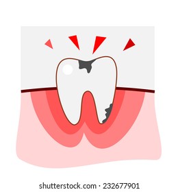 Decay Tooth Step By Step Vector