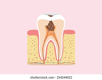 Decayed tooth anatomy in flat design version