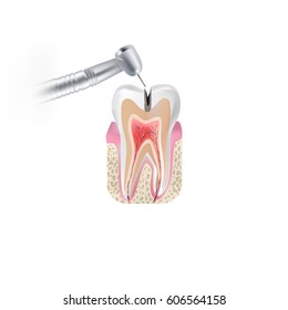 Decayed tooth with dental drill. Vector high quality illustration