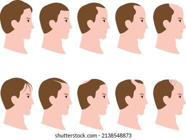  decrease in hair volume of men in profile