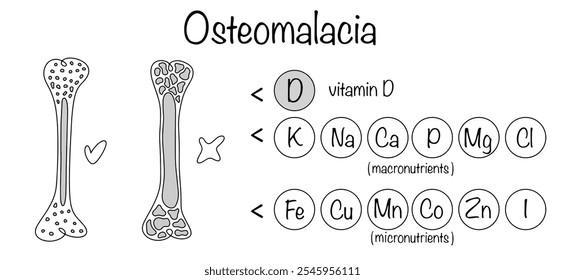 Decreased bone strength caused by insufficient mineralization of bone tissue, deficiency of vitamin D and other microelements. Hand-drawn diagram of the disease osteomalacia.