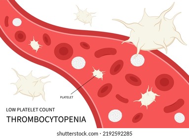 Decreased Complete Low Platelet Count Reddish Purple Spots Hepatitis C Enlarged Spleen Alcoholism Alcohol Use Disorder AIDS HIV Virus Nosebleed Hematuria Bruises Red Blood Cell