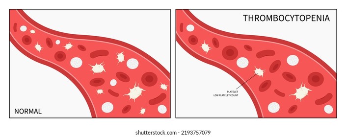 Decreased Complete Low Platelet Count Reddish Purple Spots Hepatitis C Enlarged Spleen Alcoholism Alcohol Use Disorder AIDS HIV Virus Nosebleed Hematuria Bruises Red Blood Cell
