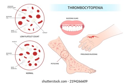 Decreased Complete Low Platelet Count Reddish Purple Spots Hepatitis C Enlarged Spleen Alcoholism Alcohol Use Disorder AIDS HIV Virus Nosebleed Hematuria Bruises Red Blood Cell