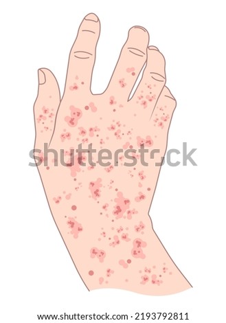 Decreased complete low platelet count reddish purple spots hepatitis C enlarged spleen alcoholism Alcohol use disorder AIDS HIV virus nosebleed hematuria bruises red blood cell