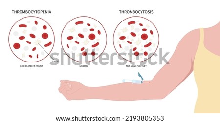 Decreased complete low platelet count reddish purple spots hepatitis C enlarged spleen alcoholism Alcohol use disorder AIDS HIV virus nosebleed hematuria bruises red blood cell