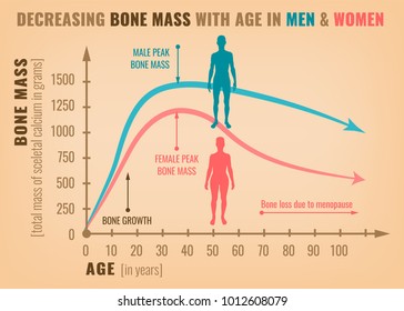 Disminución de la masa ósea con la edad en hombres y mujeres. Infografía detallada en color beige, rosa y azul.Ilustración vectorial. El concepto de salud y medicina.