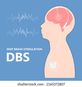 Deep brain stimulation or DBS treat Parkinson's disease PD and TMS condition major neural stimulator pulse neurological wave implanted Motor bipolar 