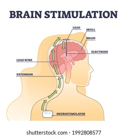 Deep brain stimulation procedure educational explanation outline diagram. DBS process example with head surgical neurostimulator electrodes implantation vector illustration. Disorders treatment scheme