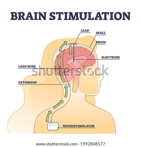 Deep brain stimulation procedure educational explanation outline diagram. DBS process example with head surgical neurostimulator electrodes implantation vector illustration. Disorders treatment scheme