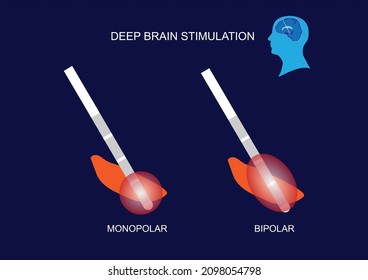Deep brain stimulation at subthalamic nucleus. Mode of stimulation. Monopolar and bipolar stimulation.