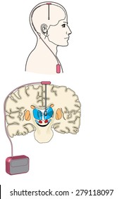 Deep brain stimulation using an implanted pulse generator, especially as it relates to Parkinson's disease. Created in Adobe Illustrator. EPS 10.