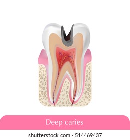 Deep caries with title. Vector illustration.