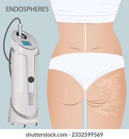 Deep cellulite reduction Body contouring Lifting with Endospheres apparatus. Physiotherapy, lymphatic drainage