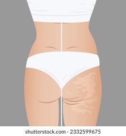 Reducción profunda de celulitis Cuerpo de contención de Levadura con aparatos de Endosferas. Fisioterapia, drenaje linfático