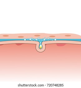 Deep cleaning unclog pores. This illustration about skin care and beauty.