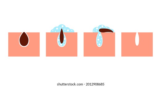 Deep cleansing of skin pores from blackheads, skin care. Procedure to wash dirt of skin of face. Removing sebum and cleaning with detergent. Vector illustration 