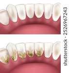 Deep Teeth Cleaning. Before and After. Teeth whitening concept. Debridement dental. Dental plaque tartar