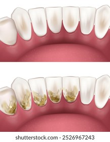 Limpeza profunda dos dentes. Antes e depois. Conceito de clareamento dos dentes. Desbridamento dentário. Tártaro de placa dentária