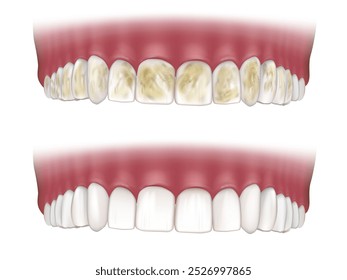 Limpieza profunda de los dientes. Antes y después. Concepto de blanqueamiento dental. Desbridamiento dental. Placa dental tártara